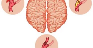 mydetox-gano-excel-ganoderma-egkefaliko-epeisodio-prolipsi-apokatastasi-2