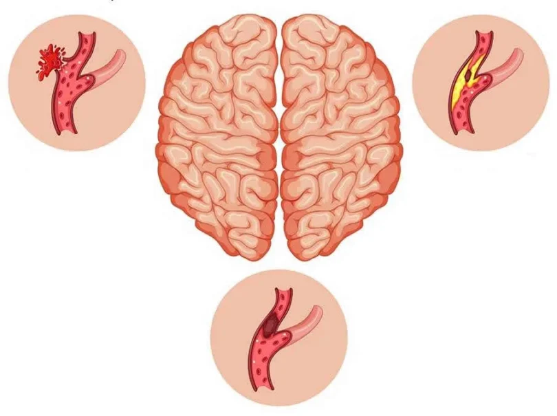 mydetox-gano-excel-ganoderma-egkefaliko-epeisodio-prolipsi-apokatastasi-2
